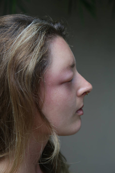 Young caucasian woman with a swollen eye from a wasp's sting. Allergy reaction on wasp bite. - Φωτογραφία, εικόνα