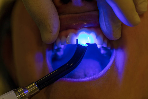 Tıp, dişçilik ve sağlık sigortası konsepti. Hastanın dişlerinde diş tedavisi UV lambası kullanan dişçiye yakın çekim. - Fotoğraf, Görsel