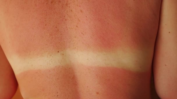 Ηλιακό έγκαυμα στην πλάτη μιας γυναίκας. Το αποτέλεσμα της έκθεσης στον ήλιο. Κόκκινο δέρμα από έγκαυμα. - Πλάνα, βίντεο