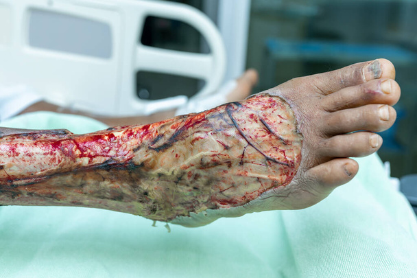 Necrosis y heridas quirúrgicas cutáneas en pacientes con diabetes en tratamiento en la unidad de cuidados intensivos
. - Foto, imagen