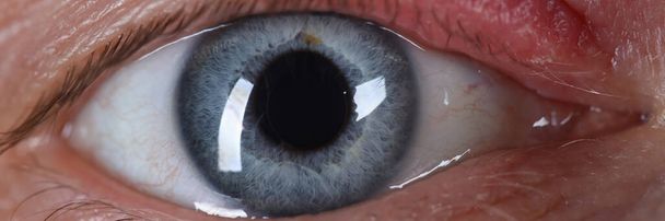 Sty en el ojo humano primer plano enfermedad de la piel
 - Foto, Imagen