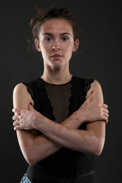 Portrait of beautiful woman with vitiligo - Foto, Imagem