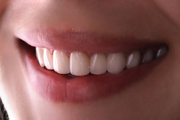 Dentes saudáveis perfeitos belo amplo sorriso branqueamento procedimento de jovem sorrindo atraente mulher lábios sexy. Tratamento de restauração dentáriaClose Up odontologia, estomatologia Odontologia
  - Foto, Imagem