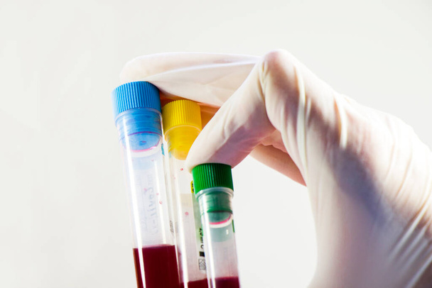 Blood test full tubes in hand, holding tubes,on the white background, studio shoot. - Zdjęcie, obraz