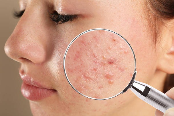 Teenage girl with acne problem visiting dermatologist, closeup. Skin under magnifying glass - Photo, image