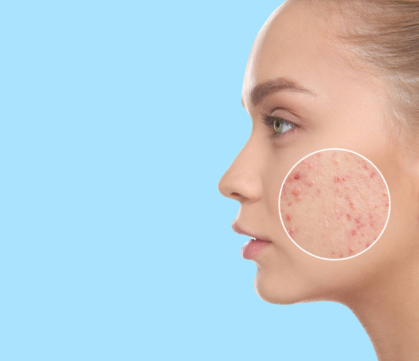 Young woman with acne problem on light blue background. Space for text - Fotó, kép