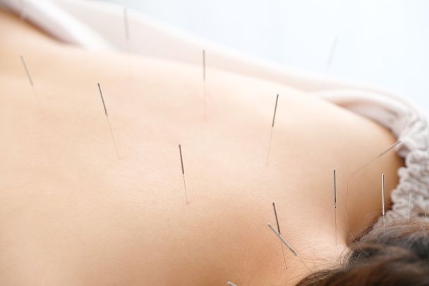 Uma mulher recebe uma agulha nas costas numa clínica de acupuntura iluminada.
 - Foto, Imagem