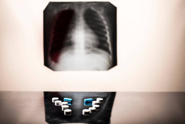結核治療の概念.肺のX線,病理学と,テーブルの上に丸薬と蓄音機.肺疾患。肺炎だ。青い背景にフォノ内視鏡による医療用フラットレイ、丸薬、 X線画像。気管支炎の治療.ケモス - 写真・画像