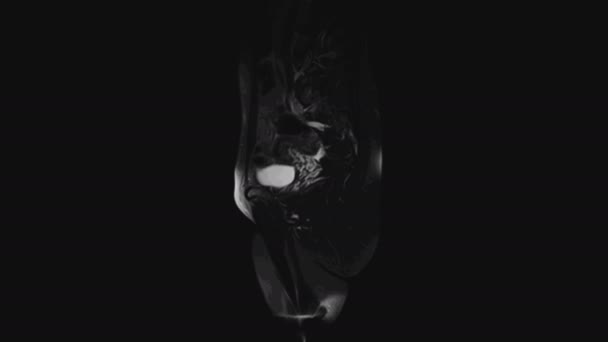 MRI of the female pelvic organs, abdominal cavity, gastrointestinal tract and bladder - Záběry, video