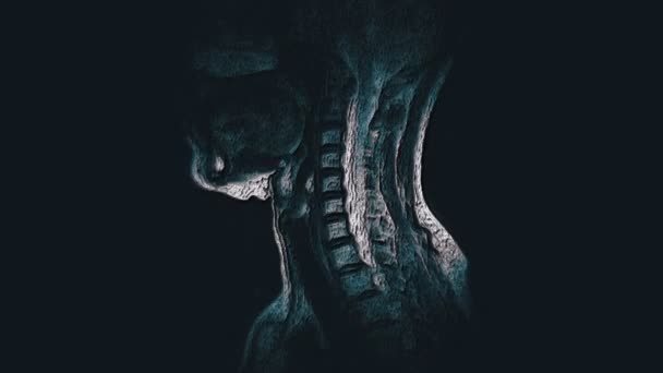 Objętościowy kolor MRI kręgosłupa szyjnego, wykrywanie występów i przepukliny - Materiał filmowy, wideo