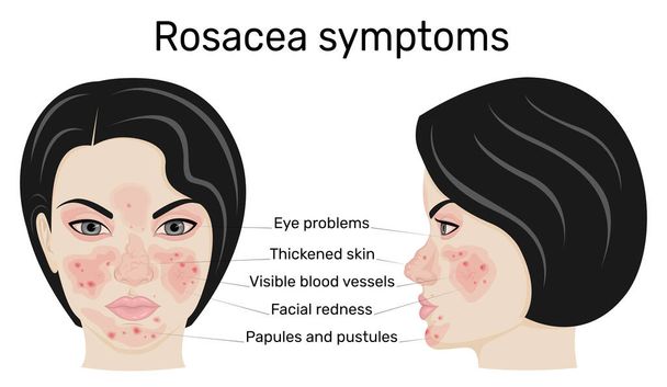 Иллюстрация симптомов розацеа на примере женского лица в полном лице и профиле
 - Вектор,изображение
