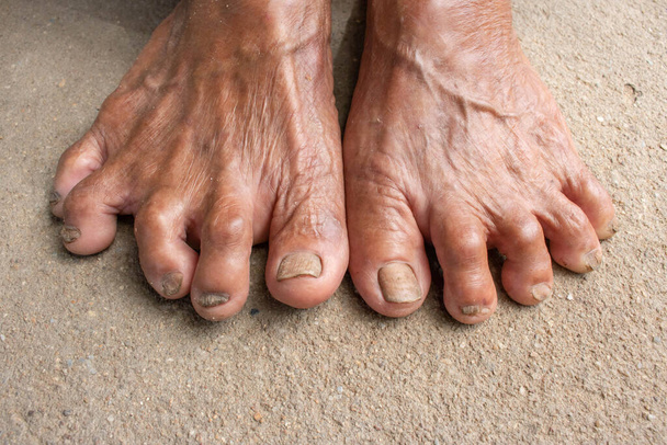 Foot Seniors. dirty feet on mortar. toenail fungus. - Photo, Image