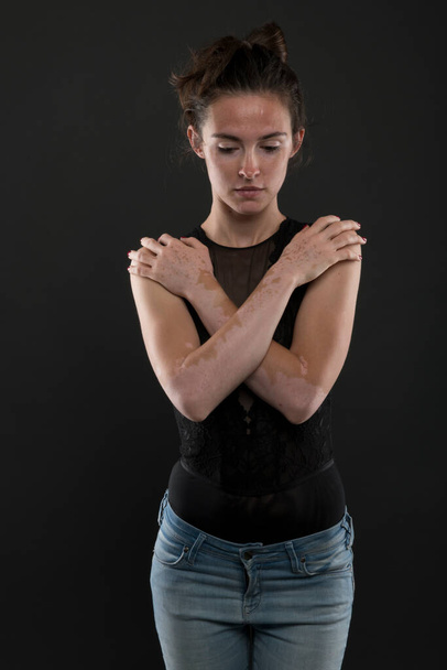 Portrait of beautiful woman with vitiligo - 写真・画像