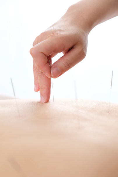A woman with a needle stuck to her back at a bright acupuncture clinic - Photo, Image