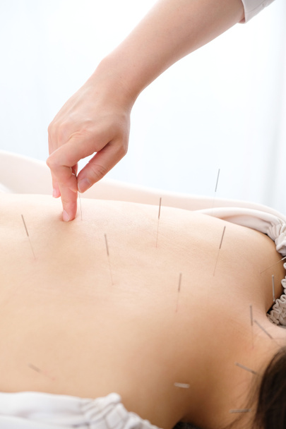 Uma mulher com uma agulha presa às costas em uma clínica de acupuntura brilhante
 - Foto, Imagem