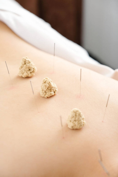 Acupuntura e moxabustão nas costas de uma mulher em um centro de acupuntura brilhante
 - Foto, Imagem