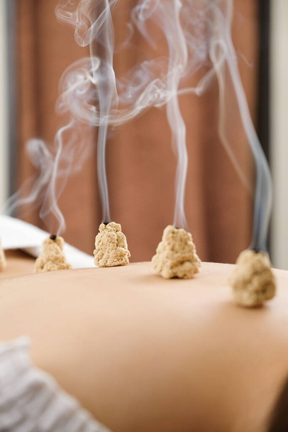 Acupuncture and moxibustion on the back of a woman in a bright acupuncture center - Photo, Image