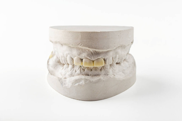 Stomatologic plaster cast, molds of human jaws and teeth on white background. Dental casting gypsum for manufacture of dentures, braces or false teeth. Dentistry and orthodontics concept. - Photo, image