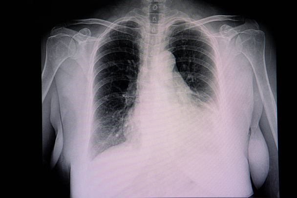 Μια ακτινογραφία θώρακος ενός ασθενούς με καρδιομεγαλία και αριστερή πλευριτική συλλογή. Κεφαλοποίηση της πνευμονικής ροής του αίματος. - Φωτογραφία, εικόνα