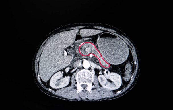 CT-Untersuchung des Bauchraums eines Patienten mit Bauchspeicheldrüsenkrebs. - Foto, Bild
