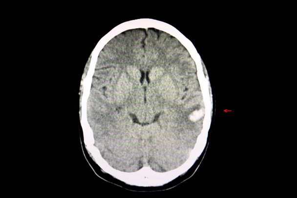 Computertomographie des Gehirns eines Patienten mit intrazerebralen Blutungen nach einem Autounfall. Ein hämorrhagischer Fleck ist senn im linken Temporalbereich. - Foto, Bild