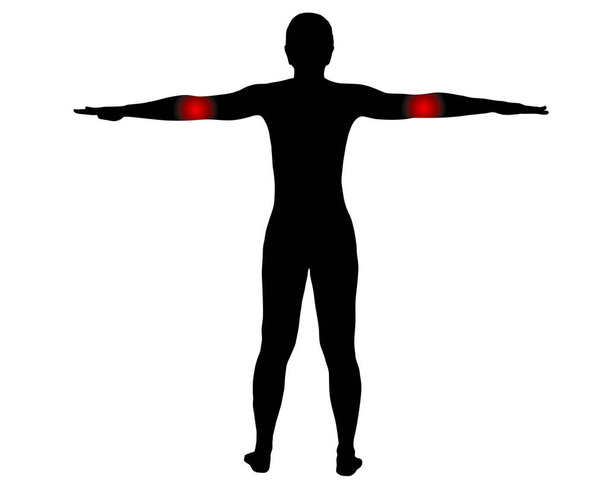 Οπίσθια όψη γυναίκας με σύμβολο πόνου στον αγκώνα - Διάνυσμα, εικόνα