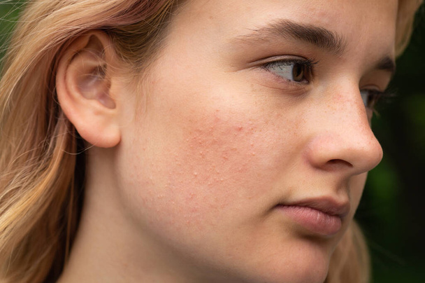 Benigní novotvary vnějšího ucha u dospívající dívky. Vrozené ušní končetiny. - Fotografie, Obrázek