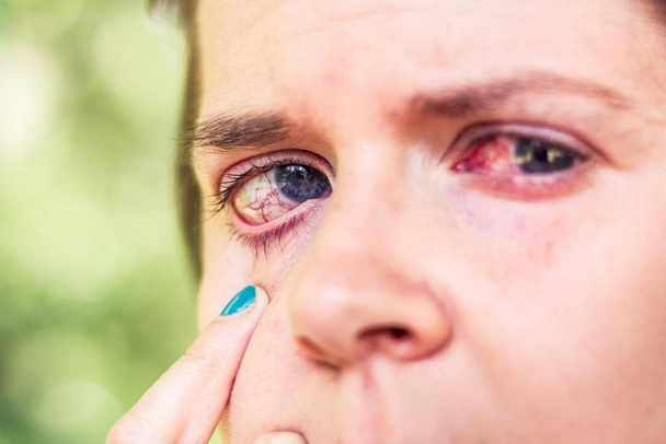 Молодая женщина с красными глазами, вызванными различными состояниями Сломанные маленькие кровеносные сосуды, которые влияют на зрение или вызывают дискомфорт глазного яблока
 - Фото, изображение