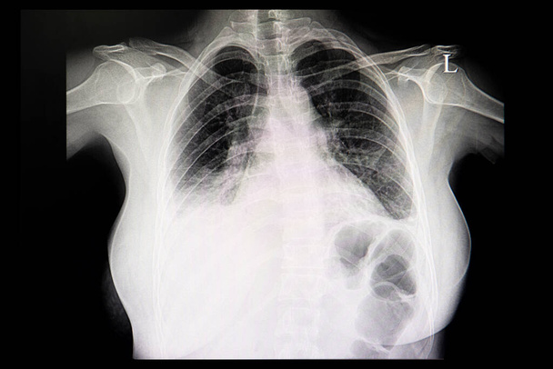Una pellicola radiografica toracica di un paziente concardiomegalia ed entrambi i polmoni versamento pleurico. - Foto, immagini