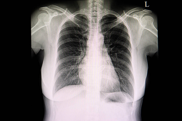 Rintakehän röntgenfilmi potilaasta, jolla on tekoläppä. - Valokuva, kuva