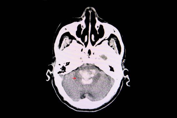 Een CT-scan van de hersenen van een patiënt met een massieve intracraniale bloeding door een bloeding. Het bloed wordt gezien in de pons.. - Foto, afbeelding
