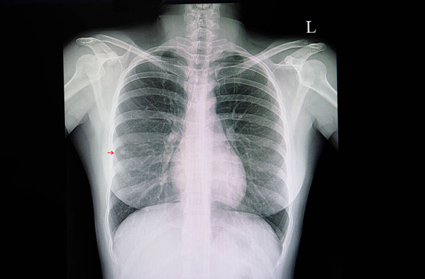 Μια ακτινογραφία θώρακος ενός ασθενούς με ένα μικρό δεξιό μέσο οζίδιο πνεύμονα. - Φωτογραφία, εικόνα