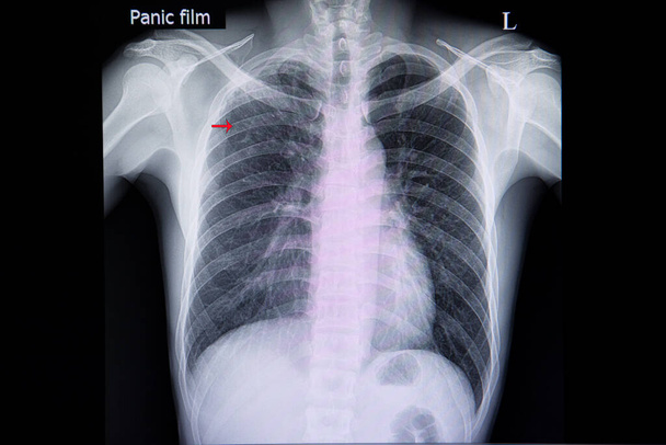 Film radiographique d'un patient atteint de tuberculose pulmonaire dans le poumon supérieur droit (flèche rouge))  - Photo, image