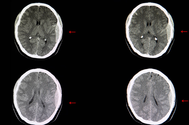 CT-scan van de hersenen van een verkeersongeval patiënt met een grote epidurale bloeding op zijn linker hersenhelft met een zekere mate van hersenoedeem - Foto, afbeelding