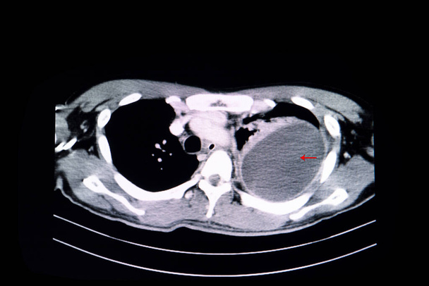 CT scan van de borst van een patiënt met grote gelokaliseerde pleurale effusie in zijn linker borstholte. Diagnostische bevindingen bij patiënten met dyspneu. Medische opleiding. - Foto, afbeelding
