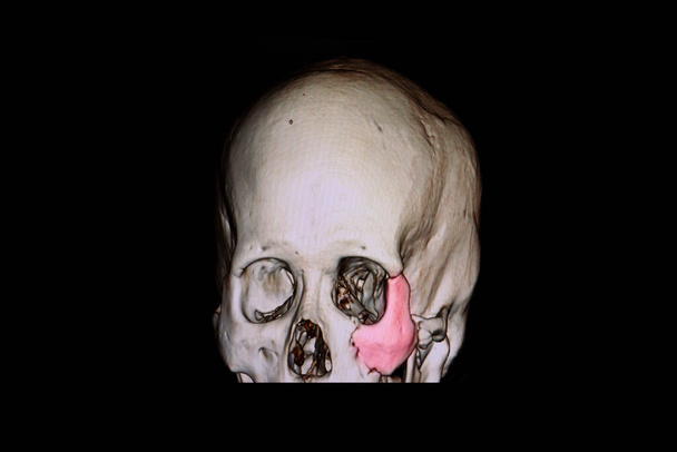 3 D απόδοση κρανίου ασθενούς με τραυματική εγκεφαλική βλάβη που δείχνει κάταγμα στο αριστερό ζυγωματικό οστό. - Φωτογραφία, εικόνα