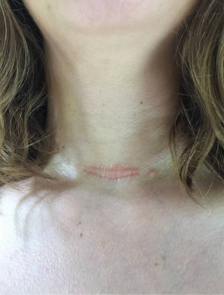 Primo piano di una cicatrice rossa, ipertrofica o cheloide sollevata sul collo di una donna un anno dopo aver subito un intervento di tiroidectomia  - Foto, immagini