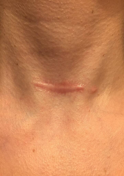 Closeup de uma cicatriz hipertrófica ou queloide levantada no pescoço de uma mulher um ano após a cirurgia de tireoidectomia
  - Foto, Imagem