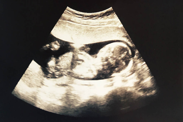2D Ultradźwiękowe zdjęcie niemowlęcia w łonie matki Z wiekiem Około 4 miesięcy Pokazuje kształt niemowlęcia - Zdjęcie, obraz