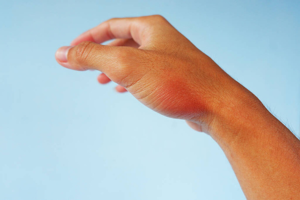 duzzanat tünet és vörös bőr a kézen Az egér fogása túl gyakran. - Fotó, kép