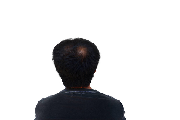 アジア人男性の頭の上の髪は、白い背景にはげ頭やグラビュラスが隔離された症状を示しています - 写真・画像