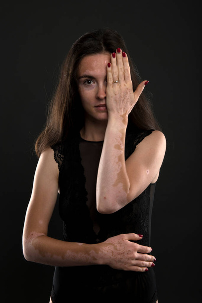 Portrait of beautiful woman with vitiligo. - Photo, Image