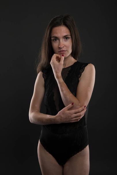 Portré gyönyörű nő vitiligo. - Fotó, kép