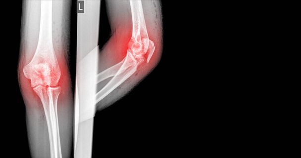 Codo de rayos X que muestra fractura (Ulna proximal o fractura de Olecranon) Destacado.Concepto de atención médica
. - Foto, imagen