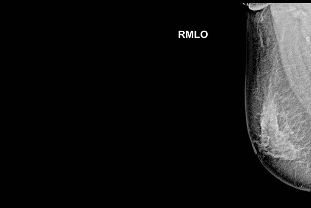 35歳以上の女性における特別マンモグラム画像(経皮的斜線- MLO)検査-右乳房。. - 写真・画像