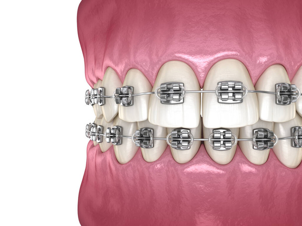 Tretament de abrazaderas metálicas, vista macro. Ilustración dental 3D médicamente precisa
 - Foto, Imagen