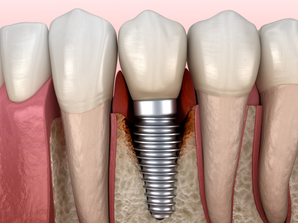 Periimplantitida s viditelným poškozením kostí. Lékařsky přesná 3D ilustrace konceptu zubních implantátů - Fotografie, Obrázek