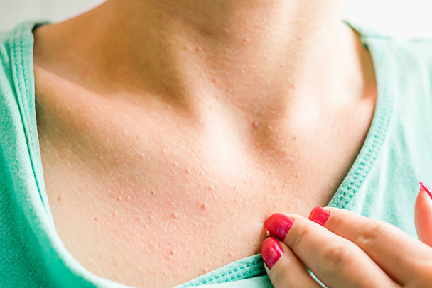 Pimples on the chest of a young woman. Allergic skin rash. - Фото, изображение