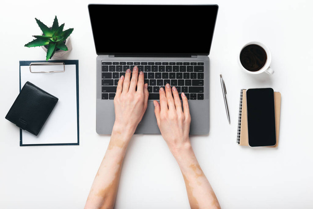 Mani femminili con pelle vitiligine digitando sul computer portatile in ufficio - Foto, immagini
