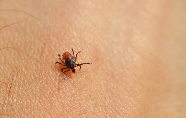 Tick (Ixodes ricinus) sulla pelle umana. Parassita trasmettere sia Lyme Borrelia e Tick-Borne Encefalite. - Foto, immagini